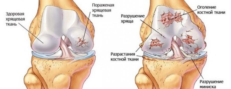 Артроз коленного сустава