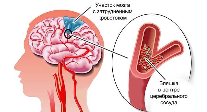 Ишемическая болезнь сердца