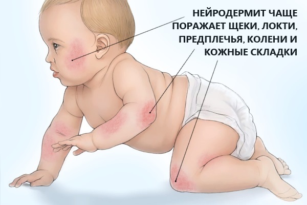 Атопический дерматит у ребенка