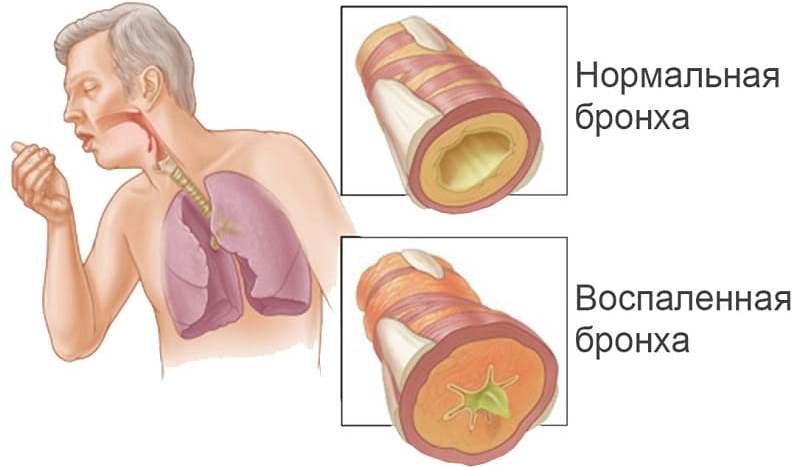 Бронхит у взрослых