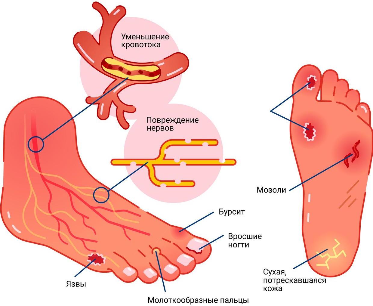 diabeticheskaya_angiopatiya_nizhnih_konechnostey