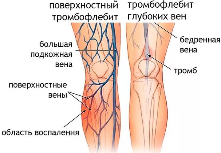 Формы тромбофлебита