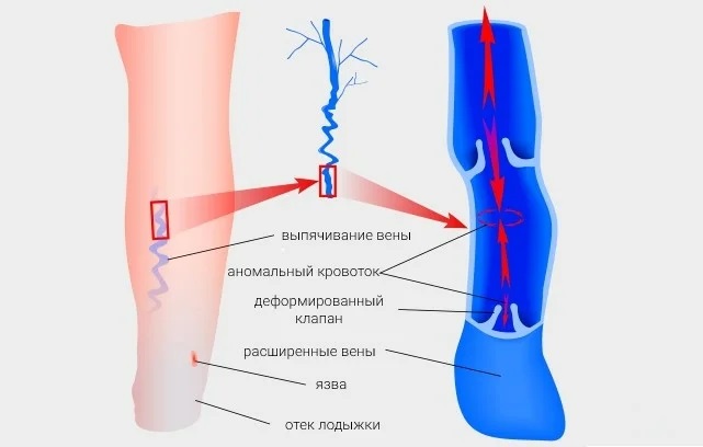 Признаки хронической венозной недостаточности