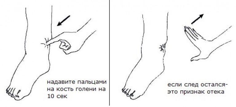 Как определить отек при лимфостазе