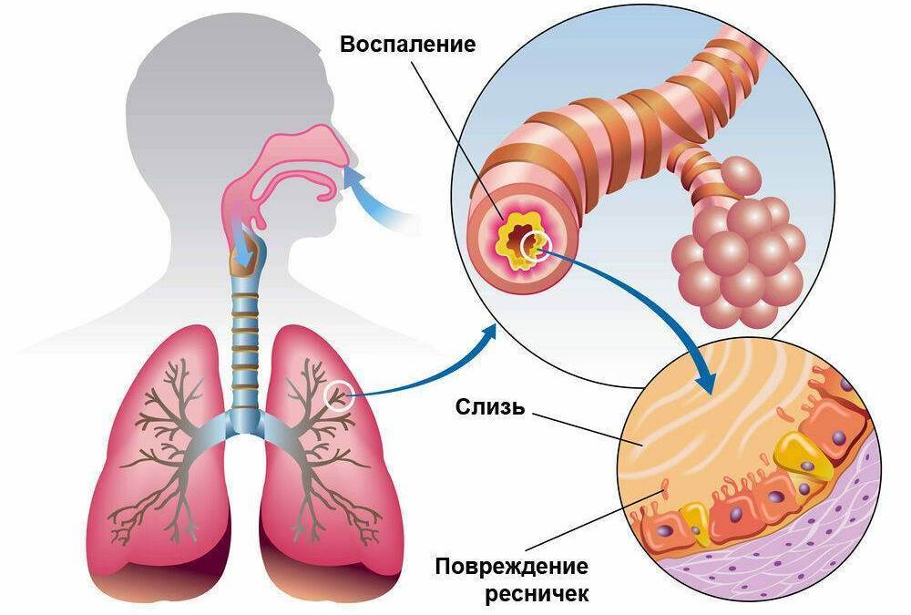 Как выглядит бронхит