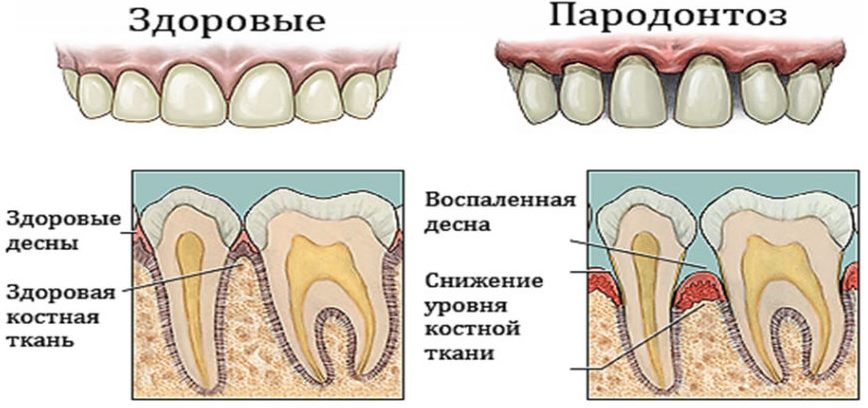 Как выглядит пародонтоз
