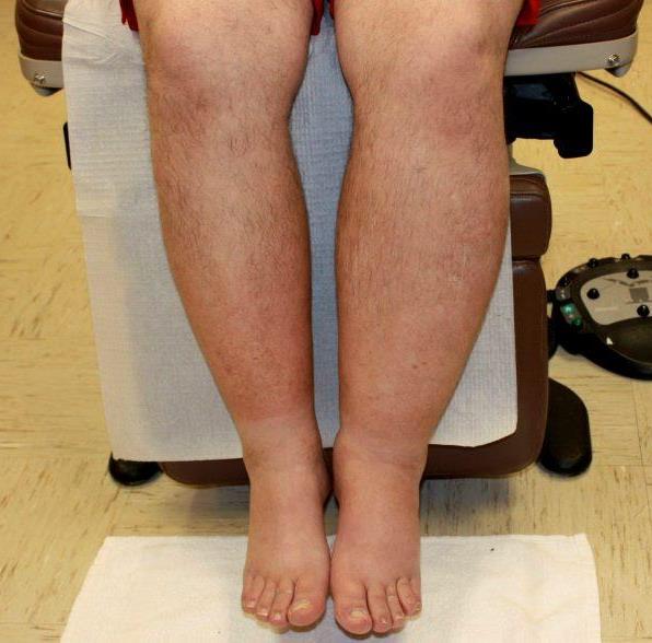 Лимфостаз на примере ног