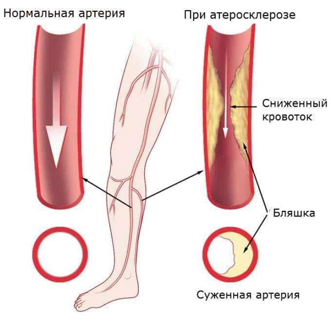 Облитерирующий атеросклероз нижних конечностей