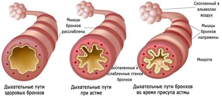 Обострение бронхиальной астмы