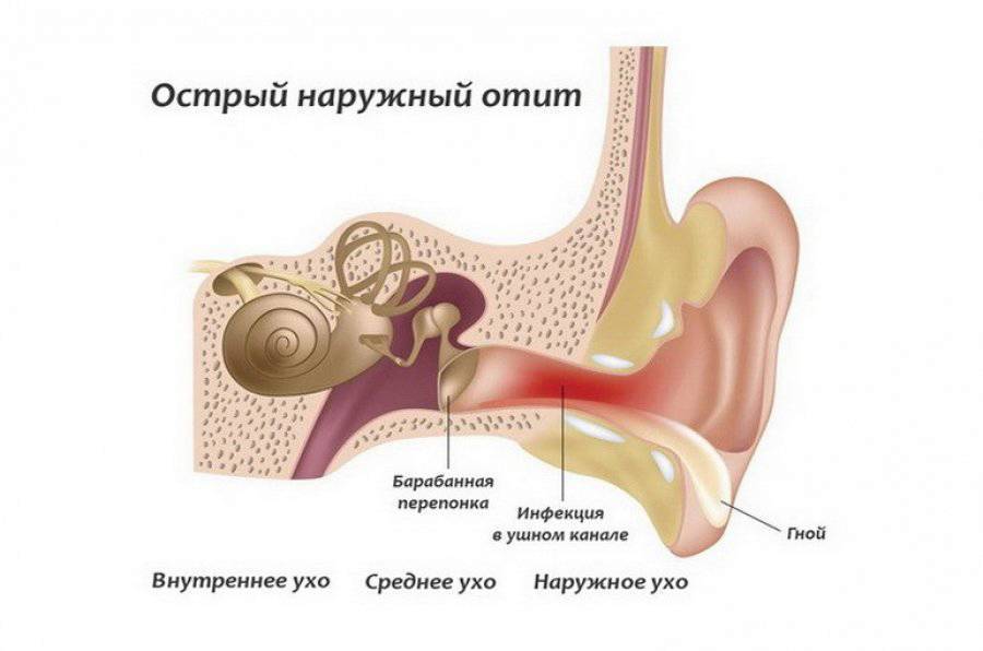 Острый наружный отит