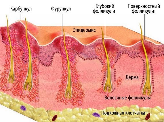 Как Выглядят Фурункулы Фото