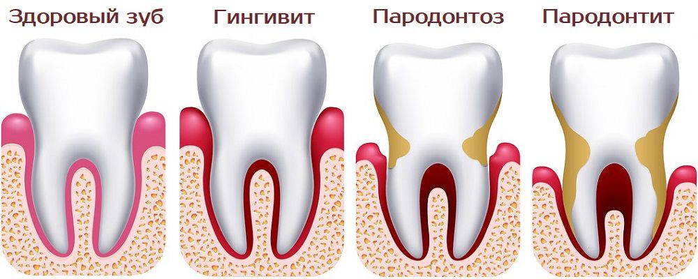 Отличия пародонтита от пародонтоза и гингивита