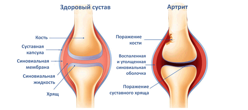 Признаки артрита