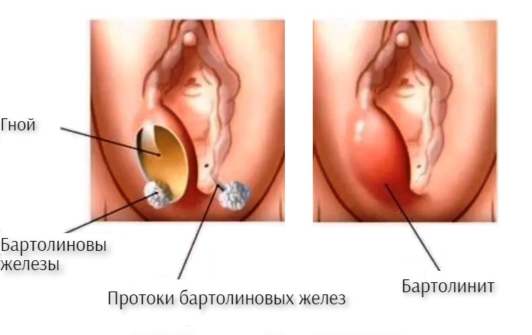 Лечение заболеваний половых органов у женщин (вагинит, бартолинит, вульвит,  кольпит) | Солнышко