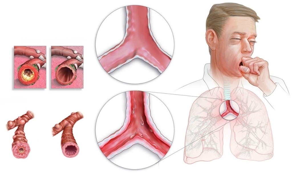 Как лечить хронический бронхит: полезная информация для пациентов
