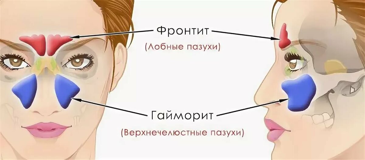 Гайморова пазуха. Гайморовы и фронтальные пазухи. Синусит гайморит фронтит.