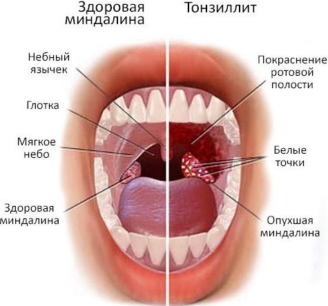 Признаки хронического тонзиллита