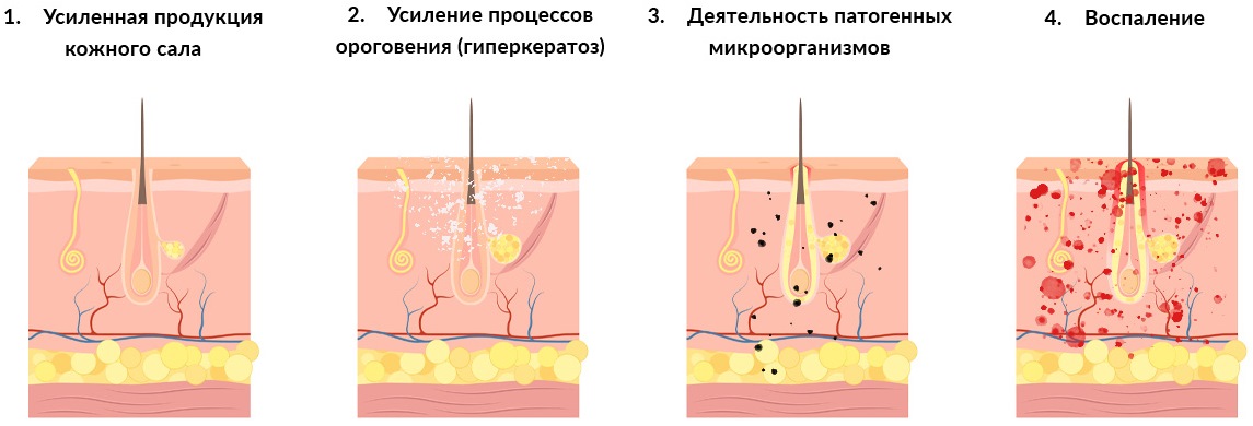 Процесс образования акне