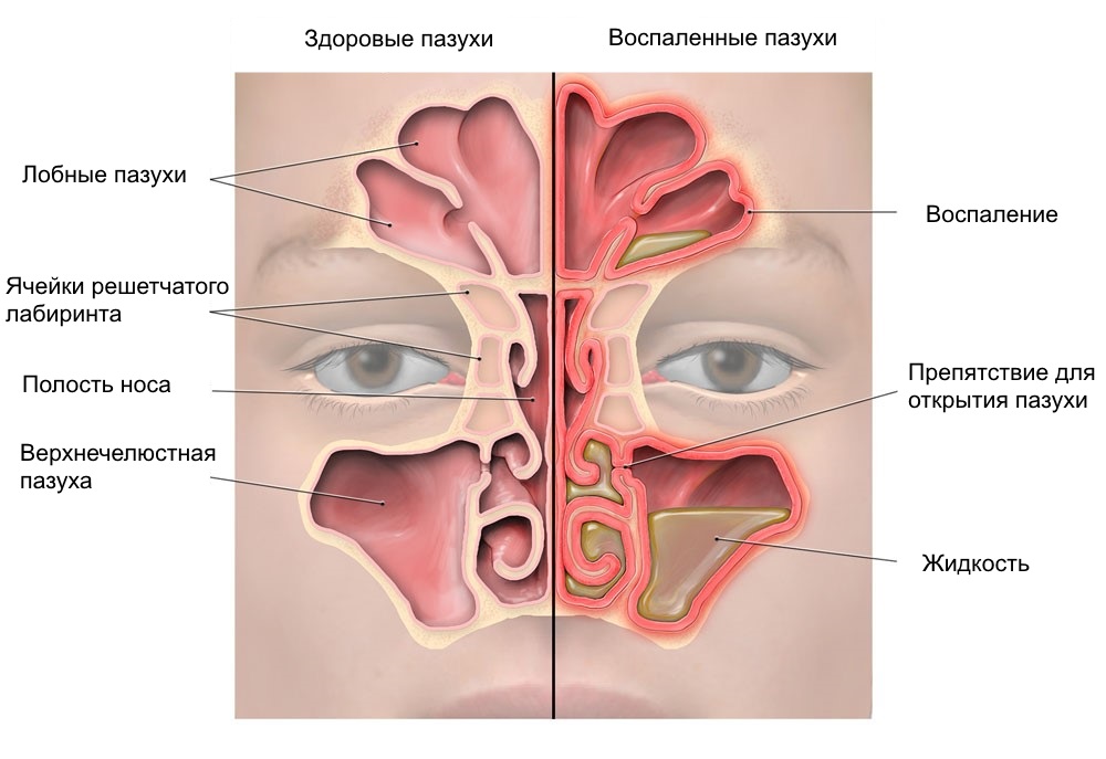 Проявление ринита