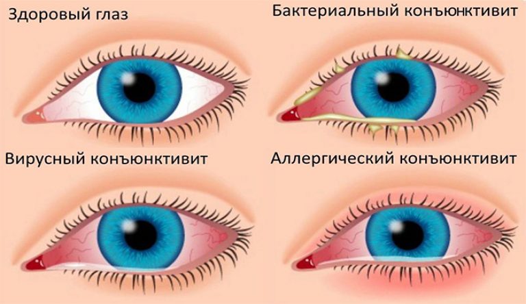 Слезятся глаза ‒ почему так происходит и что делать при частых слезотечениях Что делать, когда у ребенка закисают глаза?