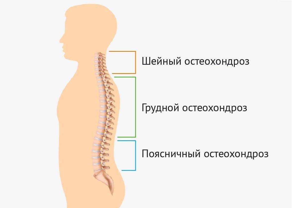 Остеохондроз шейного и грудного отдела позвоночника лечение