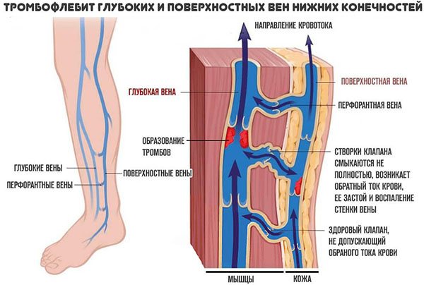 Симптомы тромбофлебита глубоких вен нижних конечностей
