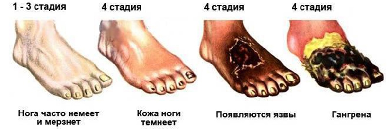 Стадии атеросклероза