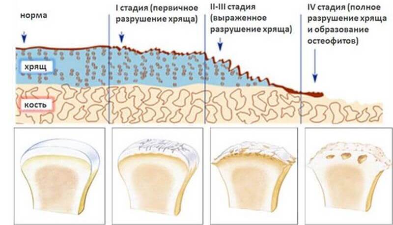 Стадии деформирующего артроза