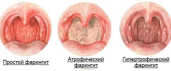 Стадии хронического фарингита