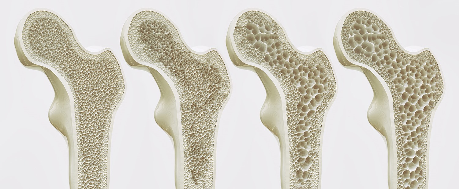 Стадии развития остеопороза