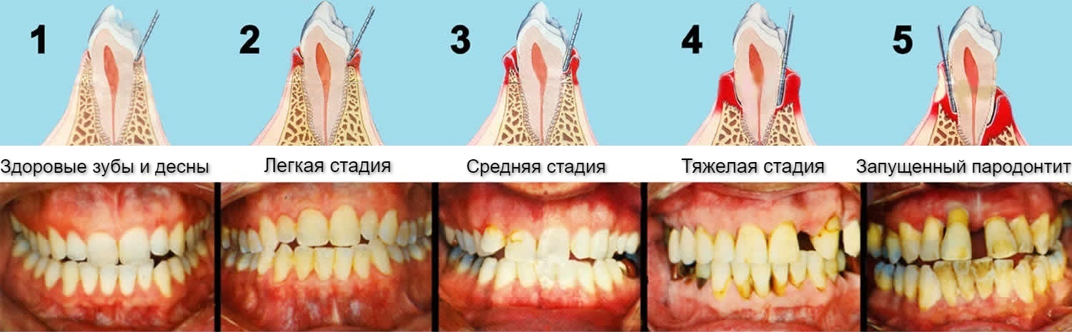 Стадии пародонтита