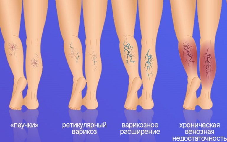 Стадии развития хронической венозной недостаточности