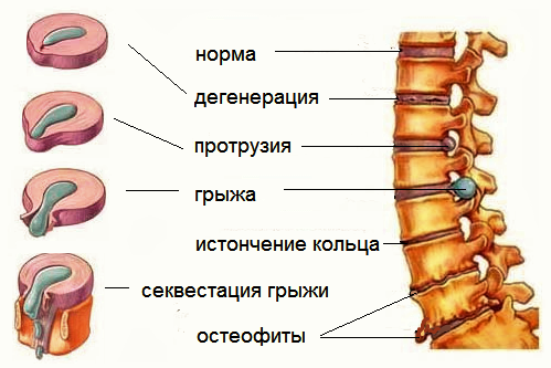 Остеохондроз – что делать?