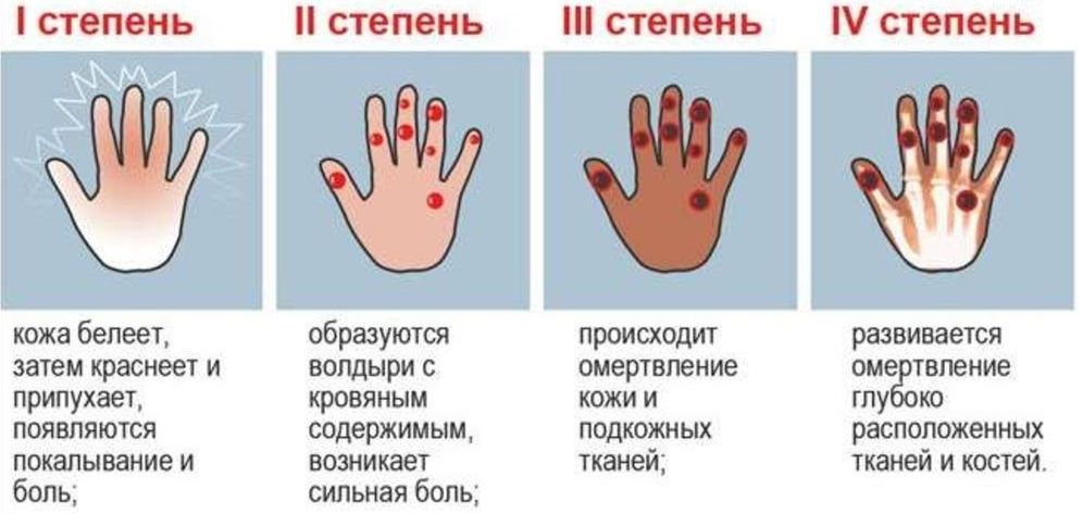 Обморожения 1, 2, 3 и 4 степени