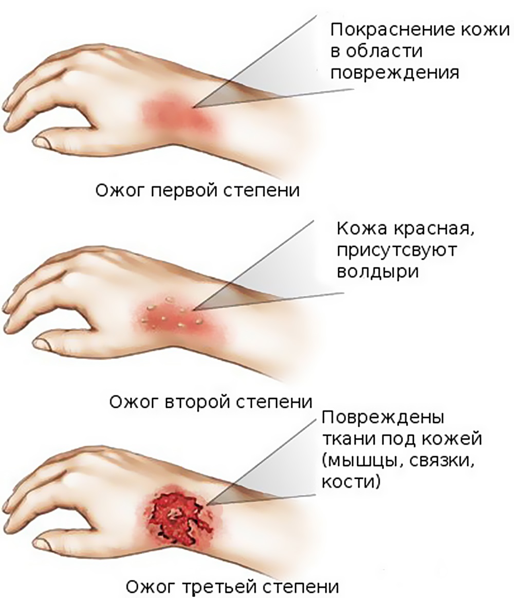 Лечение обширных ран: гнойных, после ожогов и обморожений | Солнышко