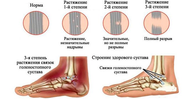 Ушиб голеностопа как распознать и как лечить