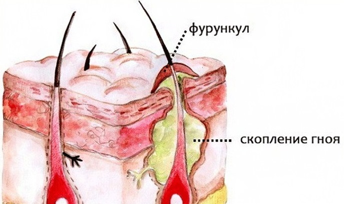 Причины фурункула