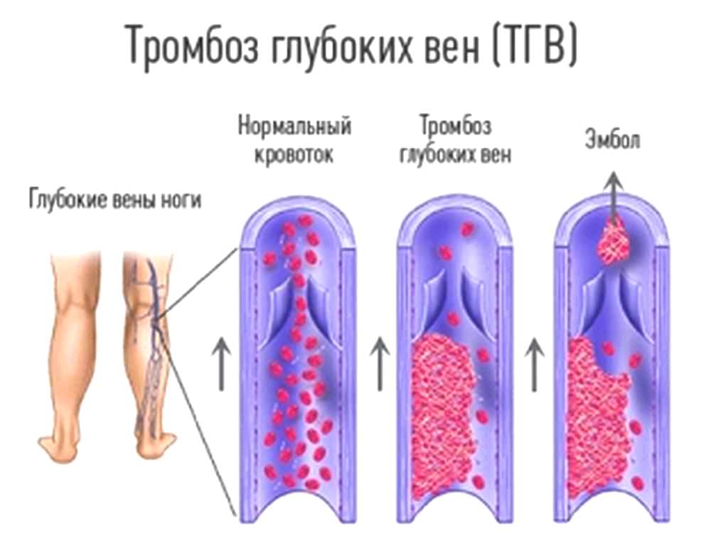 Осложнение: тромбоз глубоких вен