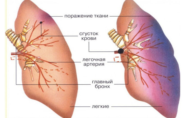 Тромбоз легких