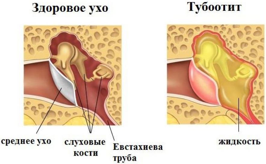 Лечение отита народными средствами - gairbru Лечение отита