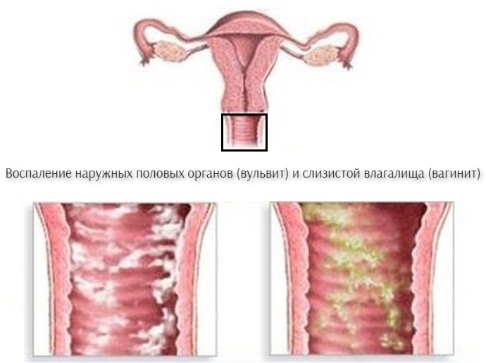 Лечение заболеваний половых органов у женщин (вагинит, бартолинит, вульвит,  кольпит) | Солнышко