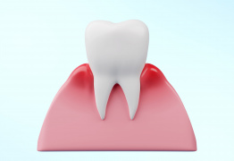 Гингивит - воспаление вокруг зуба